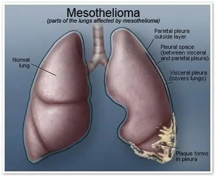 Reducing the Risk of Mesothelioma